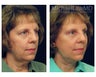 Facelift