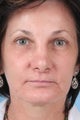 Facelift
