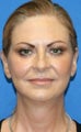 Facelift, Fat Transfer, Upper Bleph, Lower Eyelid Skin Pinch