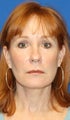 2 years post op: Facelift, Lower Eyelid Skin Pinch, and Peri-orbital Fat Transfer