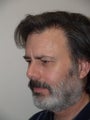 Midfacelift/Chin Implant/1800 Hair Grafts