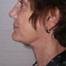 Facelift