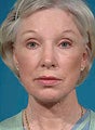 Facelift