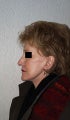 Facelift