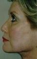 Facelift