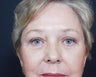 Facelift
