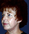 Facelift