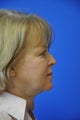 Facelift