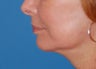 Facelift