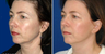Facelift