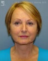 Facelift & Eyelid Surgery