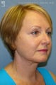 Facelift & Eyelid Surgery