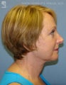 Facelift & Eyelid Surgery