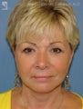 Facelift & Eyelid Surgery