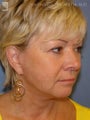 Facelift & Eyelid Surgery