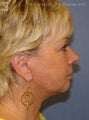 Facelift & Eyelid Surgery