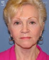 Facelift, Eyelid Surgery & Chin Implant