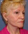 Facelift, Eyelid Surgery & Chin Implant