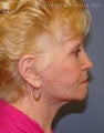 Facelift, Eyelid Surgery & Chin Implant