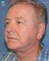 Facelift & Eyelid Surgery