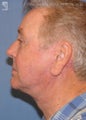 Facelift & Eyelid Surgery