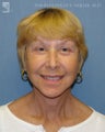Facelift, Brow Lift & Eyelid Surgery