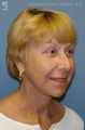 Facelift, Brow Lift & Eyelid Surgery