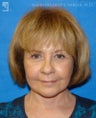 Facelift and Eyelid Surgery