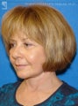 Facelift and Eyelid Surgery