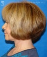 Facelift & Eyelid Surgery