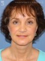 Facelift, Brow Lift & Eyelid Surgery