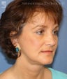 Facelift, Brow Lift & Eyelid Surgery