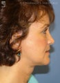 Facelift, Brow Lift & Eyelid Surgery