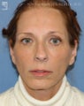 Facelift, Brow Lift, Eyelid Surgery & Chin Implant