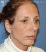 Facelift, Brow Lift, Eyelid Surgery & Chin Implant
