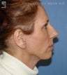 Facelift, Brow Lift, Eyelid Surgery & Chin Implant