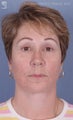 Facelift, Brow Lift & Eyelid Surgery