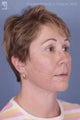 Facelift, Brow Lift & Eyelid Surgery