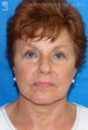 Facelift, Brow Lift & Eyelid Surgery