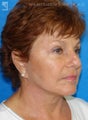 Facelift, Brow Lift & Eyelid Surgery