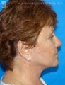 Facelift, Brow Lift & Eyelid Surgery