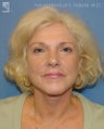 Facelift, Eyelid Surgery & Dermabrasion