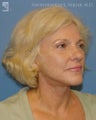 Facelift, Eyelid Surgery & Dermabrasion