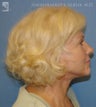 Facelift, Eyelid Surgery & Dermabrasion