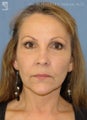 Facelift, Brow Lift & Eyelid Surgery