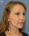 Facelift, Brow Lift & Eyelid Surgery
