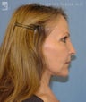 Facelift, Brow Lift & Eyelid Surgery