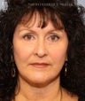 Facelift & Eyelid Surgery