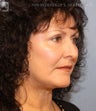 Facelift & Eyelid Surgery