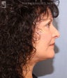 Facelift & Eyelid Surgery